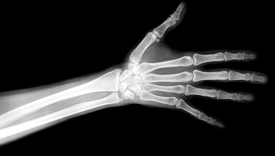 photo of an arm x-ray
